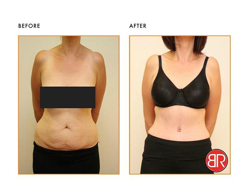 Abdominoplasty Patient-Before After
