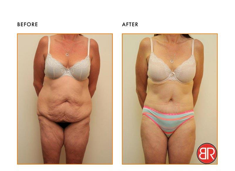 Abdominoplasty Patient-Before After