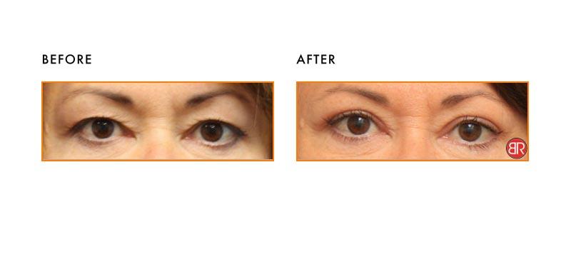 Blepharoplasty Patient-Before After