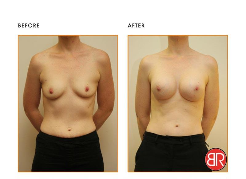 Breast Asymmetry Patient