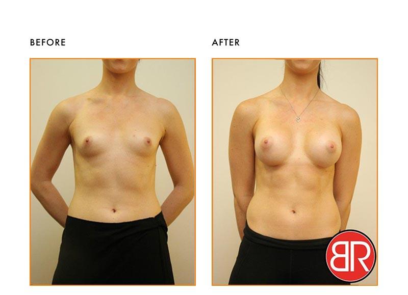 Breast Augmentation Patient-Before After