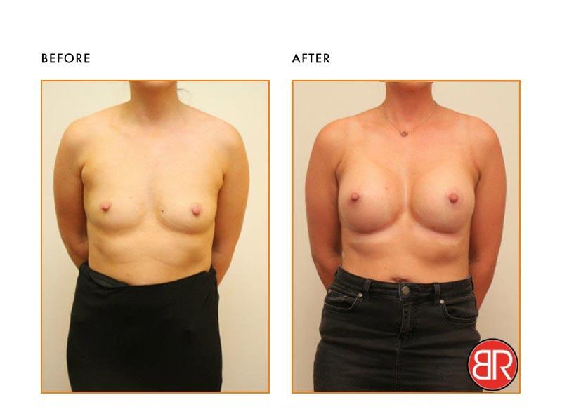 Breast Augmentation Patient-Before After