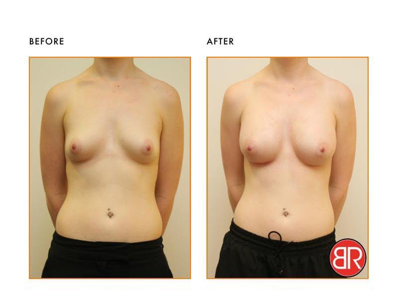 Breast Augmentation Patient- Before After
