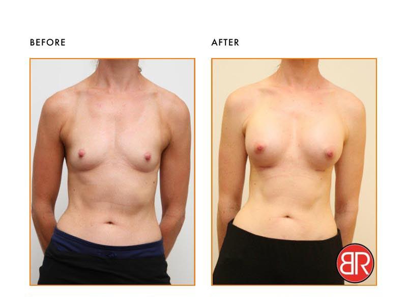 Breast Augmentation Patient- Before After