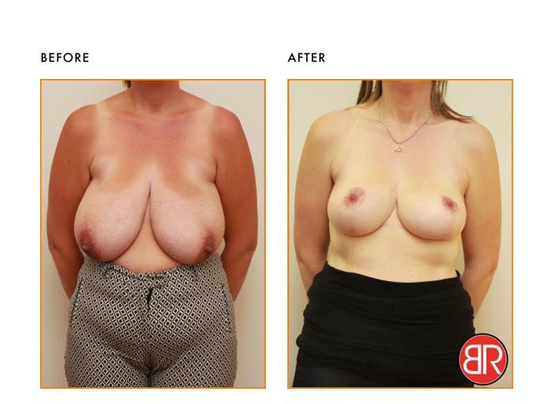 Breast Reduction Patient-Before After