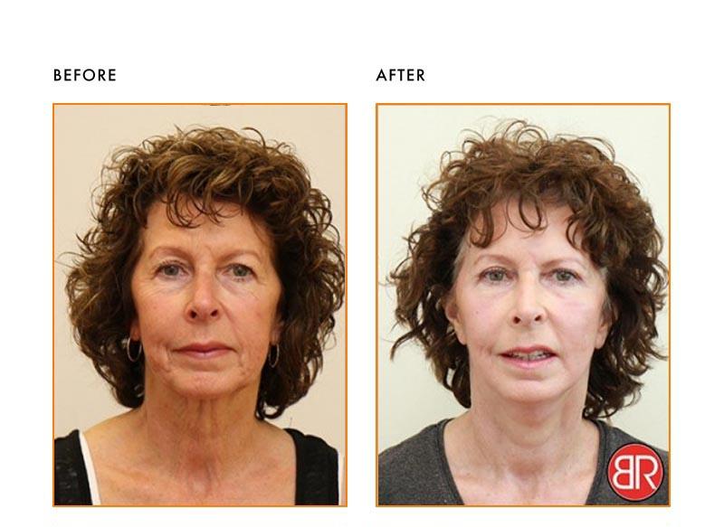 Facial Rejuvenation Patient