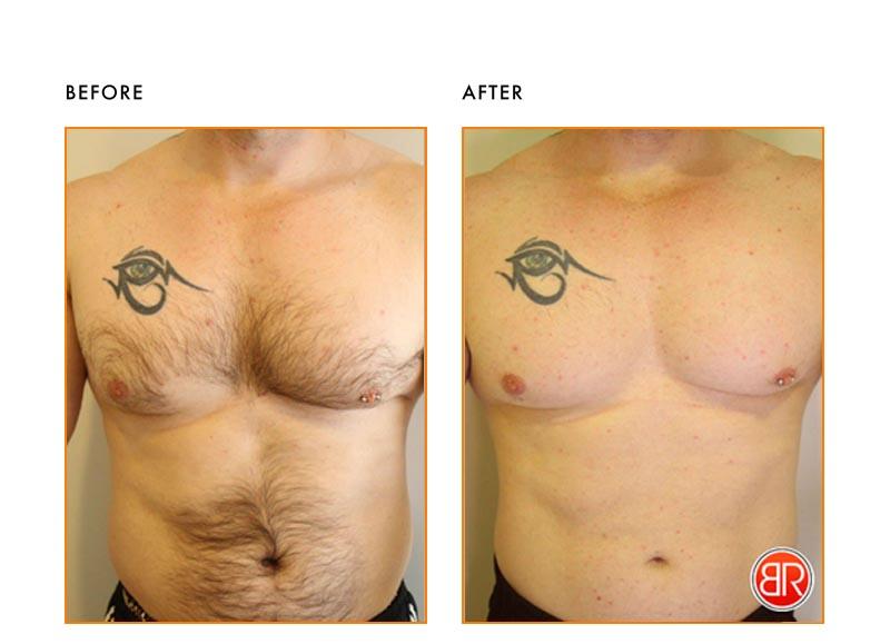 View Laser Hair Removal Before and After Images