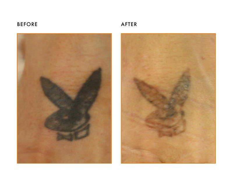 Tattoo Removal Patient-Before After
