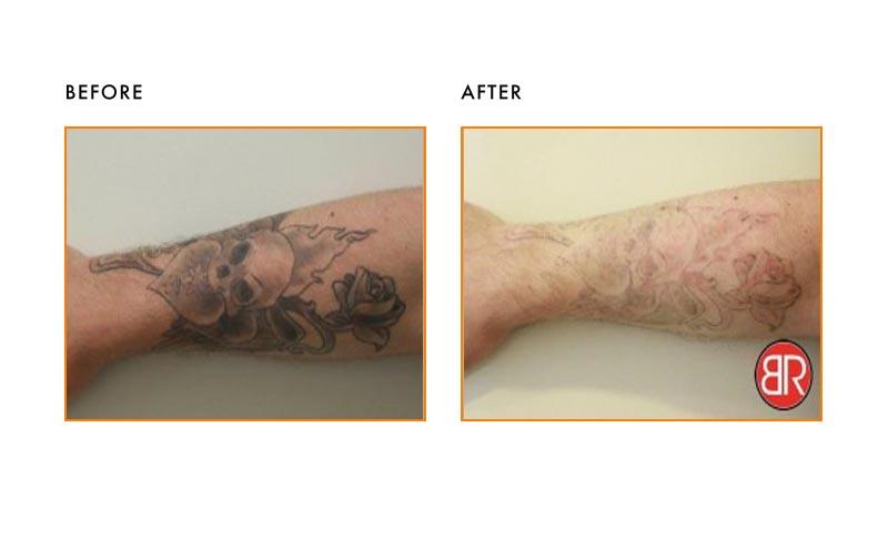 Tattoo Removal Patient