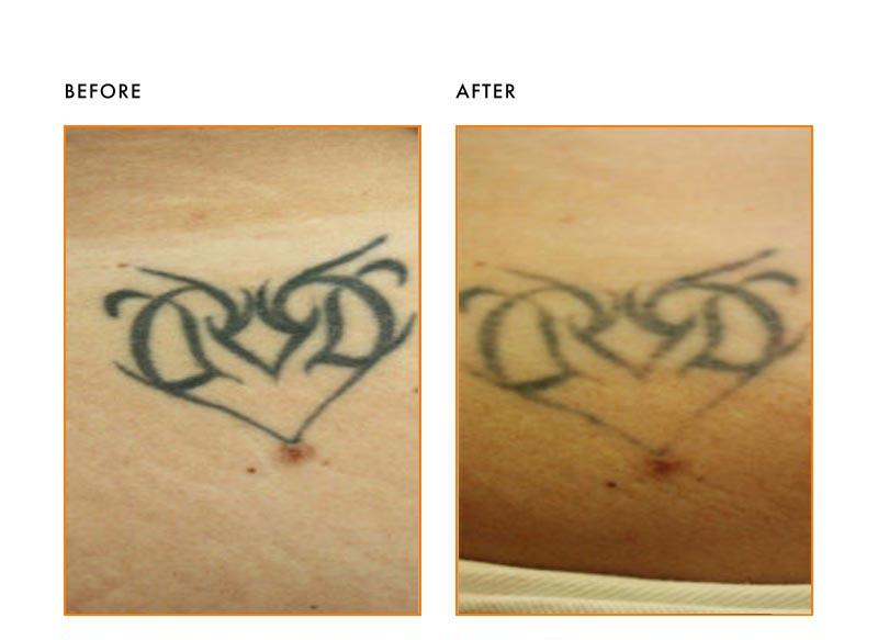 View Tattoo Removal Before and After Images