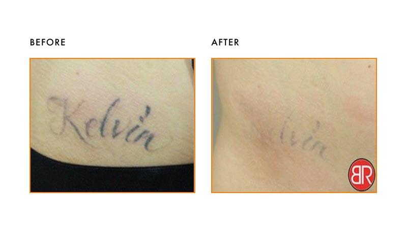 Tattoo Removal Patient