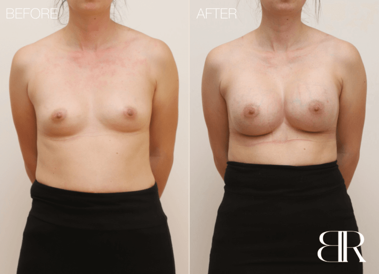 Body Recon - Plastic Surgery Geelong - Patient 4328 - Breast Augmentation 1