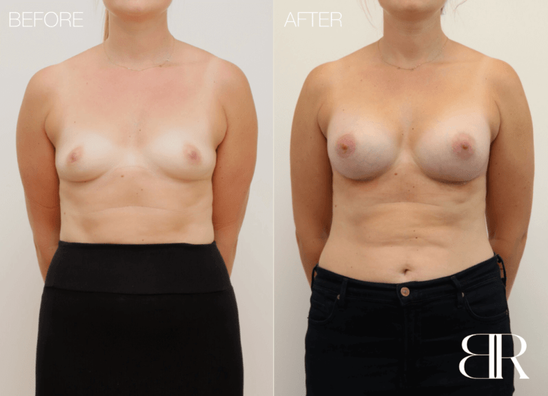 Body Recon - Plastic Surgery Geelong - Patient 4336 - Breast Augmentation 1